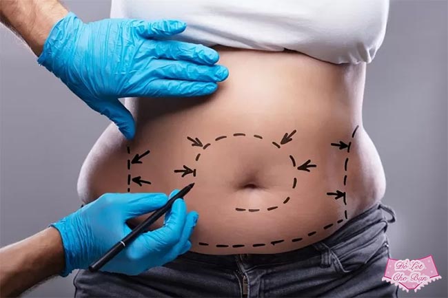 Phẫu thuật tạo hình thành bụng hay quần gen lụa nịt bụng nâng mông?